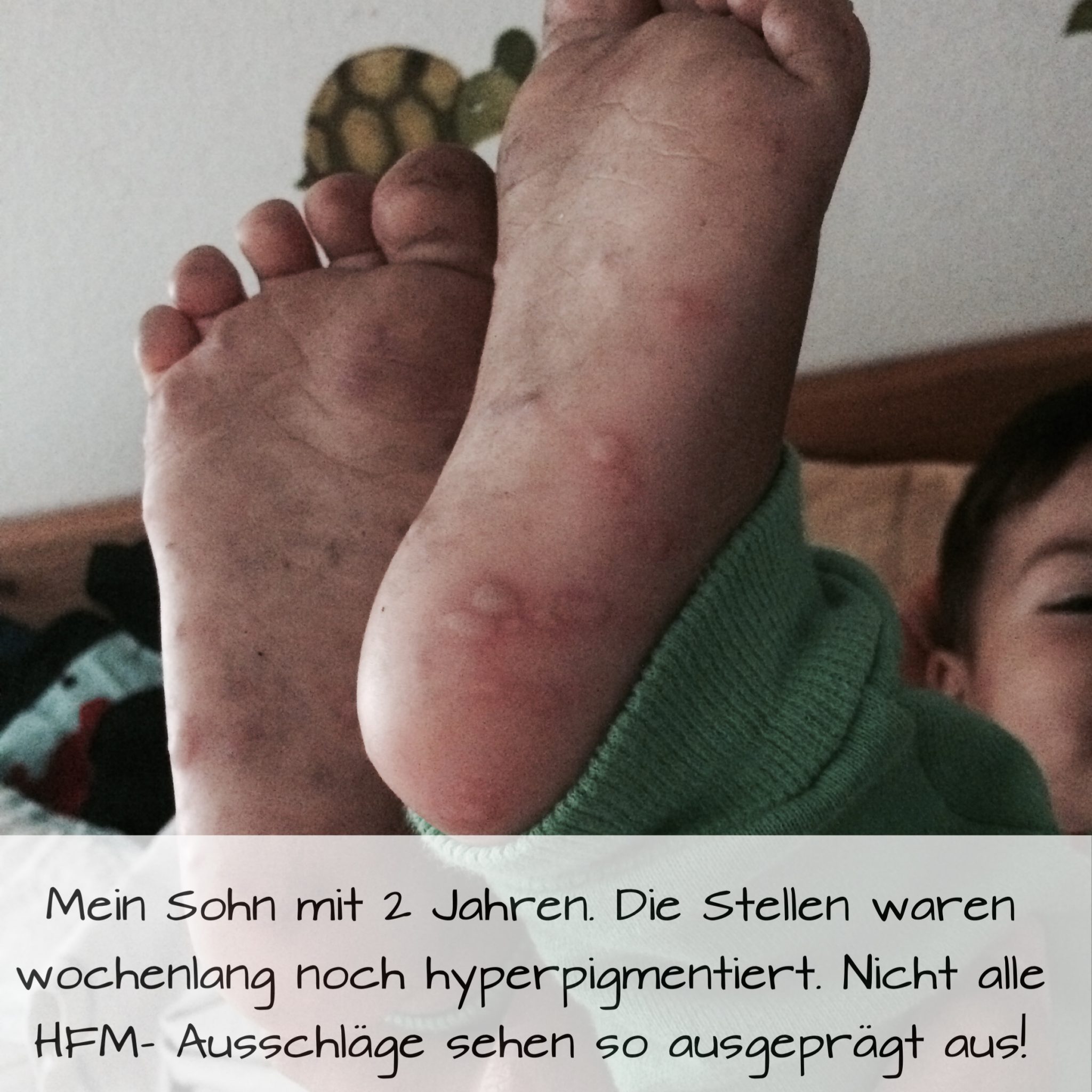 Die Hand-Fuß-Mund-Krankheit: eine Qual für Kinder und Erwachsene | Dr. Mami